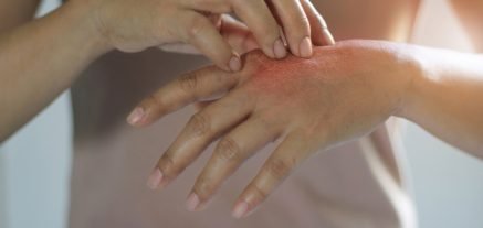Woman scratching hand / eczema