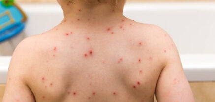 Image of patient with Chickenpox
