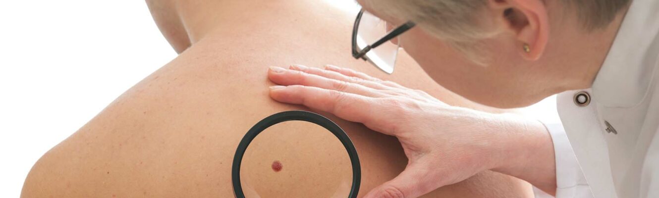 Patient skin check for Melanoma
