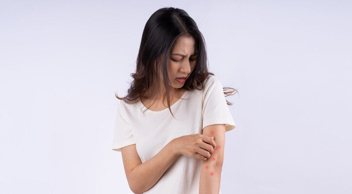 Patient with itchy hives on arm.