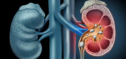 Anatomical picture of kidney stones obstructing the kidney.