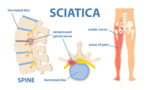 sciatica-24-7-medcare