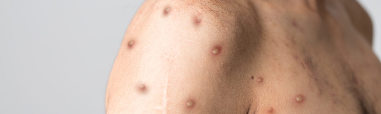 monkeypox virus 24-7medcare